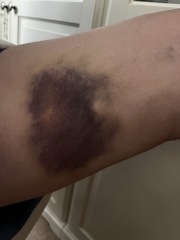 Large black bruise getting worse