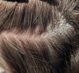 Eczema or psoriasis? (pictures)