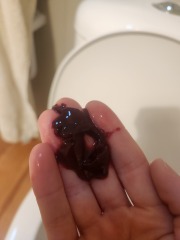 GRAPHIC PICS - Is this a miscarriage