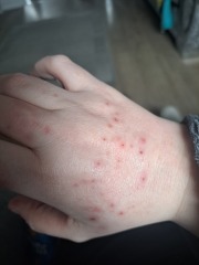 Pupps or scabies?!! Help!