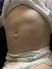 Soft lump/bulge toddlers stomach