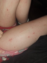 Pupps or scabies?!! Help!