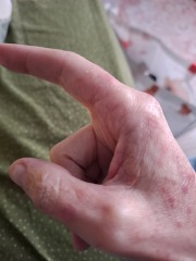 Hand infected (Warning, gross photos)