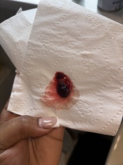 Is this a miscarriage ? TW picture includes