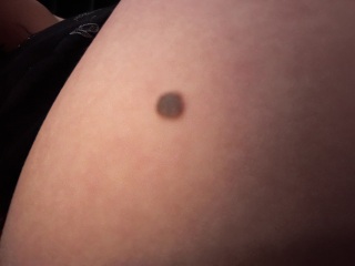 Mole getting bigger
