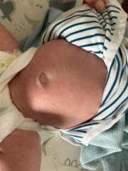 Does this sound like CMPA?