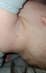 Baby rash