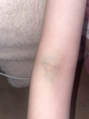 My daughter is really tired after a blood test