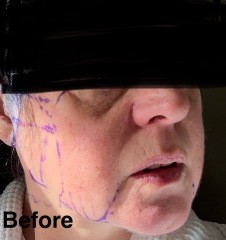 Having facelift surgery in 10 days - support and advice needed