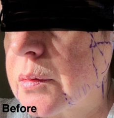 Having facelift surgery in 10 days - support and advice needed