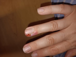 Hangnail Wound - What to Do?