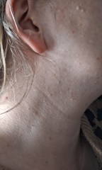 Bumps on face and neck