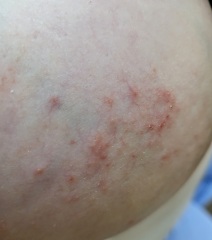 Rash on breast