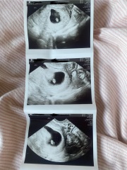 No growth between scans?