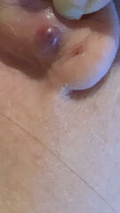 Popped large sebaceous cyst