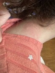 Worried - unknown allergy ? 😟