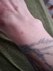 Hand infected (Warning, gross photos)