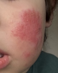 Eczema on 2 year old face