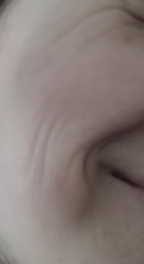 Microneedling, polynucleotides, radio frequency skin tightening?