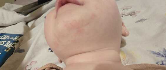 Worried about a rash?