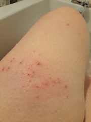 Pupps or scabies?!! Help!
