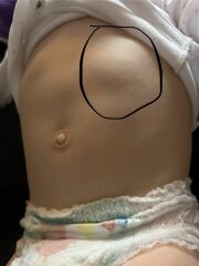 Soft lump/bulge toddlers stomach