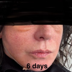 Having facelift surgery in 10 days - support and advice needed
