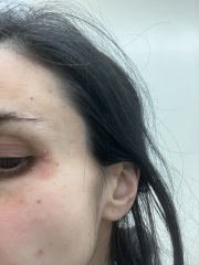 Psoriasis or eczema