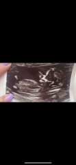 Boy or girl just for fun. 13 week scan ?