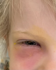 In hospital with DD age4 - peri orbital cellulitis, antibiotics not working?