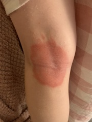 Eczema?