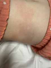 Worried - unknown allergy ? 😟