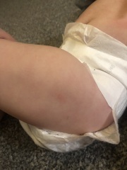 6 month old has red spots ? What are these spots??