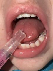 White sores toddlers tongue?