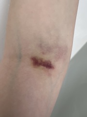 Bruising