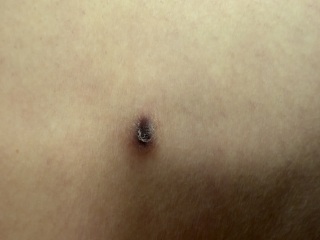 Skin lesion? Scared