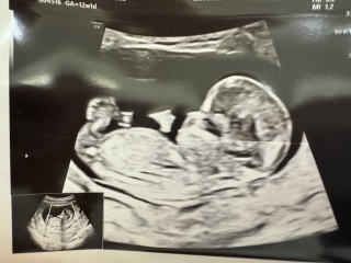 Visible nub? 12 weeks
