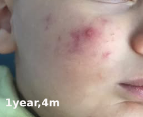 Infantile Acne / Baby Acne at 5 months