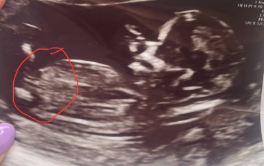 Nub theory ! Boy or girl ?
