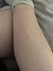 Bed bugs or fleas