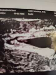Could this be 2 sacs??
