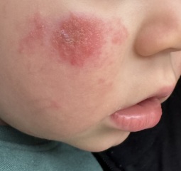 Eczema on 2 year old face