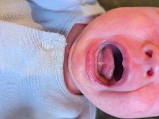 Tongue tie