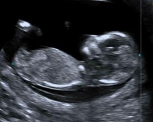 Girl or boy?