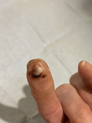 Cut finger - will the tip survive? **TW** Photos