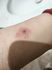 Does this look like a tick bite?