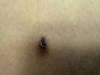 Skin lesion? Scared