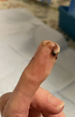 Cut finger - will the tip survive? **TW** Photos