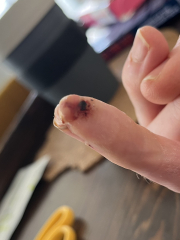 Cut finger - will the tip survive? **TW** Photos