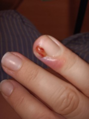 Hangnail Wound - What to Do?
